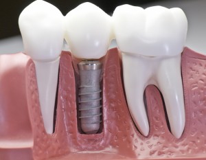implantes-dentales-coronas