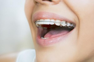 retenedor-dental